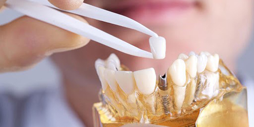 The lack of even one tooth negatively affects the function of chewing and deforms the dentition (row of teeth). Prosthetics is the most important section of dentistry, which restores the integrity and aesthetics of the dentition, as well as the function of chewing in case of loss of one or more teeth, as well as in the complete absence of teeth.