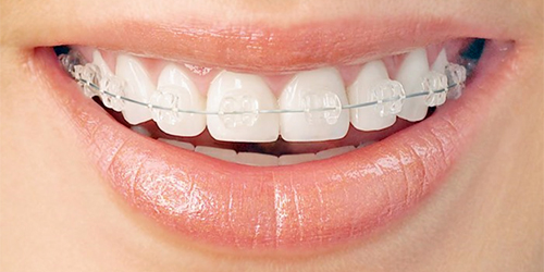 Orthodontics is a branch of dentistry dealing with the treatment and prevention of anomalies in the development of teeth and maxillofacial skeleton, depending on hereditary factors, as well on the conditions of growth and development of the child's body in the embryonic period and after birth.
Crooked teeth, incorrect bite, dental factors are a fairly common pathology among patients of all ages. If there are signs of pathology, we recommend getting in touch with a dentist for advice and timely correction.